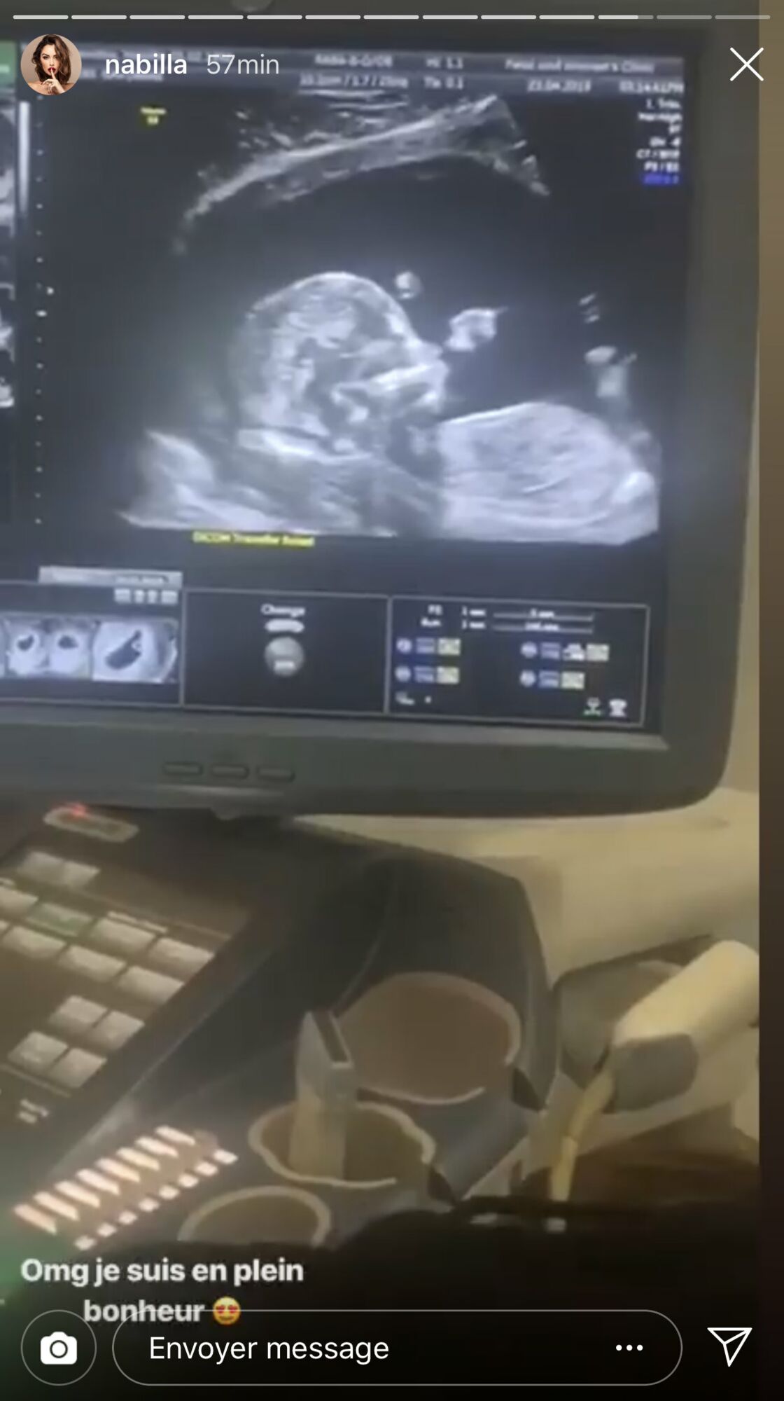 Photo Nabilla Enceinte Elle Devoile Une Echographie De Son Bebe Voici