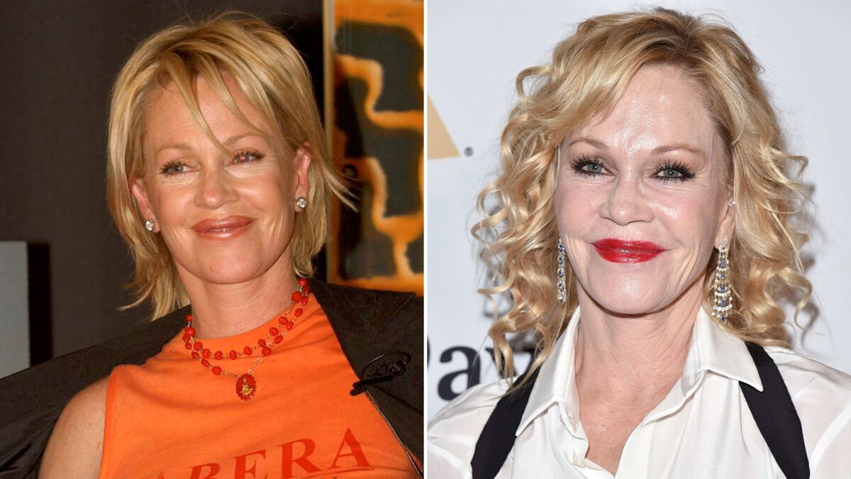 Star Chirurgie Esthetique Ratee Avant Apres PHOTOS Avant/Après : ces stars qui ont VRAIMENT abusé de la chirurgie  esthétique - Voici