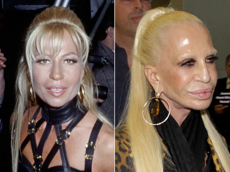 Dona­tella Versace Son Effroyable Trans­for­ma­tion Physique En 14 Photos Voici 