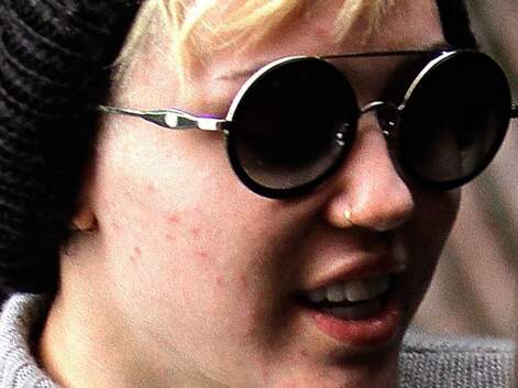 Miley Cyrus victime d’une éruption cutanée